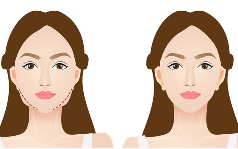 Mô phỏng mặt sau hút mỡ (Nguồn: Internet)