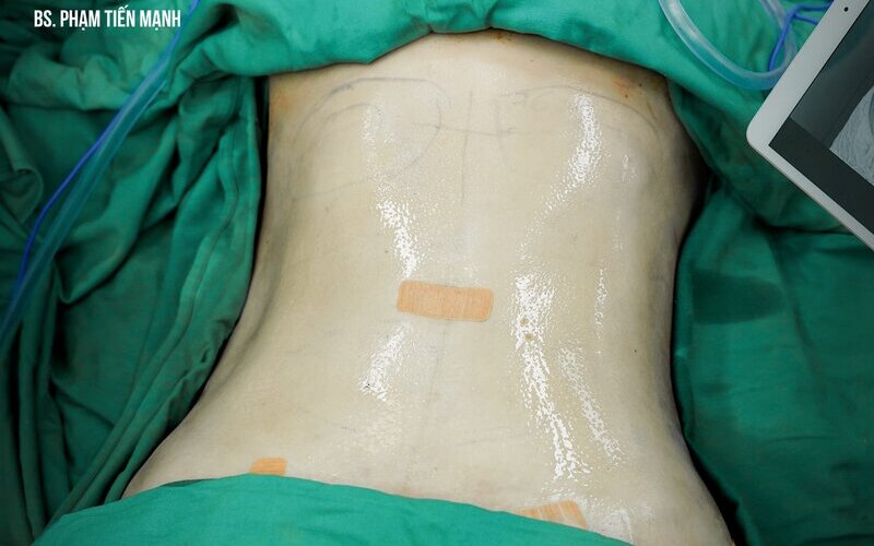 Top 8 địa chỉ hút mỡ uy tín nhất tại Nghệ An – Giúp bạn lấy lại vóc dáng mơ ước