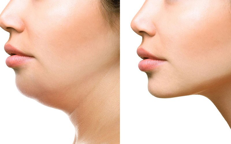 Hút mỡ nọng cằm (Nguồn: Internet)
