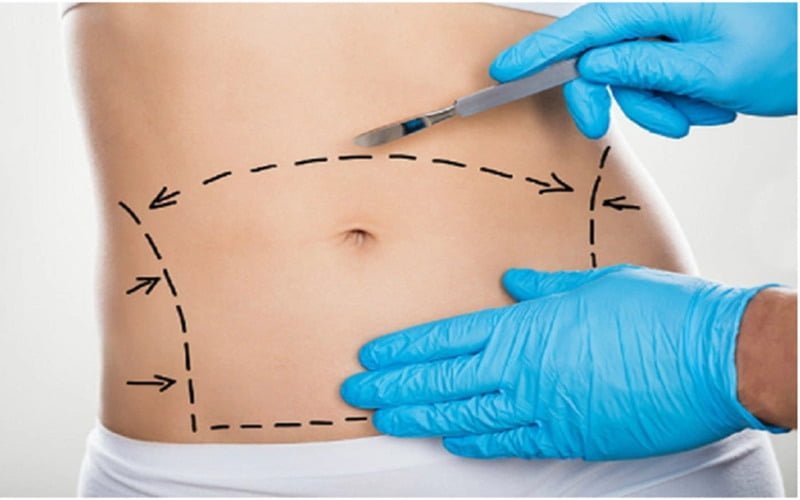 Hút mỡ tạo hình thành bụng (Nguồn: Internet)