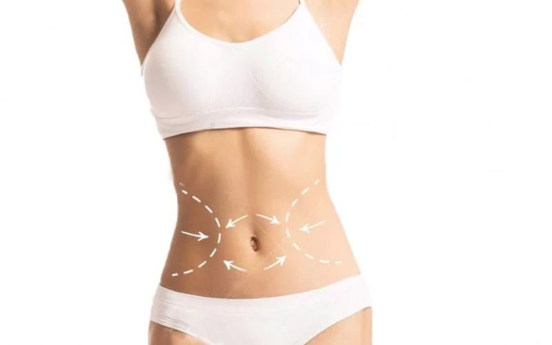 Bụng hết mờ thừa nhờ hút mỡ (Nguồn: Internet)