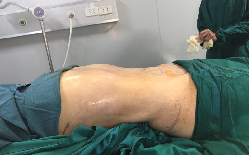 Tiến hành hút mỡ tạo hình thành bụng (Nguồn: Internet)