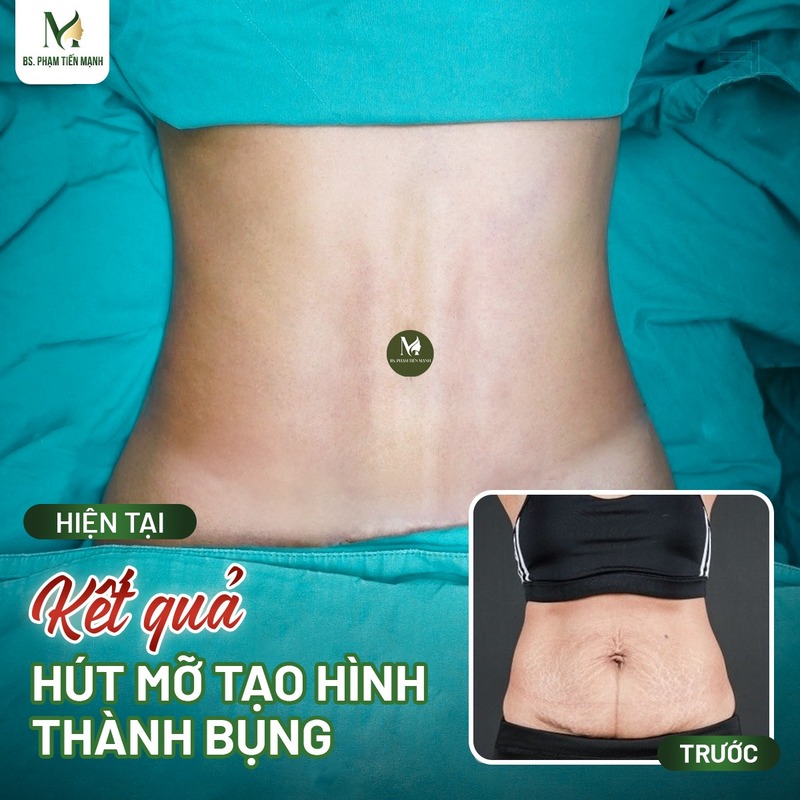 Hút mỡ tạo hình thành bụng: Chìa khóa cho vòng 2 thon gọn