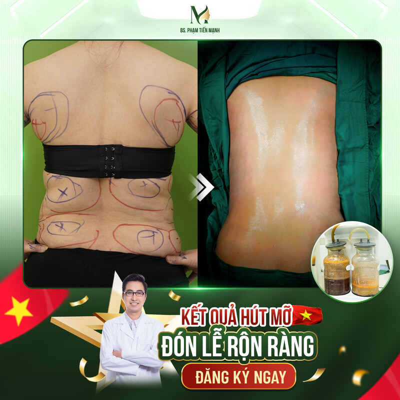 Dịch vụ hút mỡ toàn thân an toàn chuẩn y khoa tại Thẩm Mỹ MD Change Life (Nguồn: Thẩm Mỹ MD Change Life)