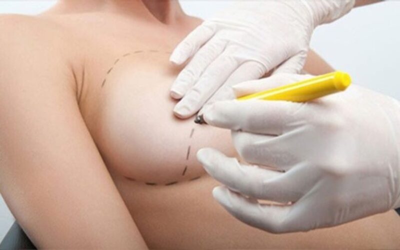 Kéo núm vú: Giải pháp tối ưu cho vòng 1 hoàn hảo