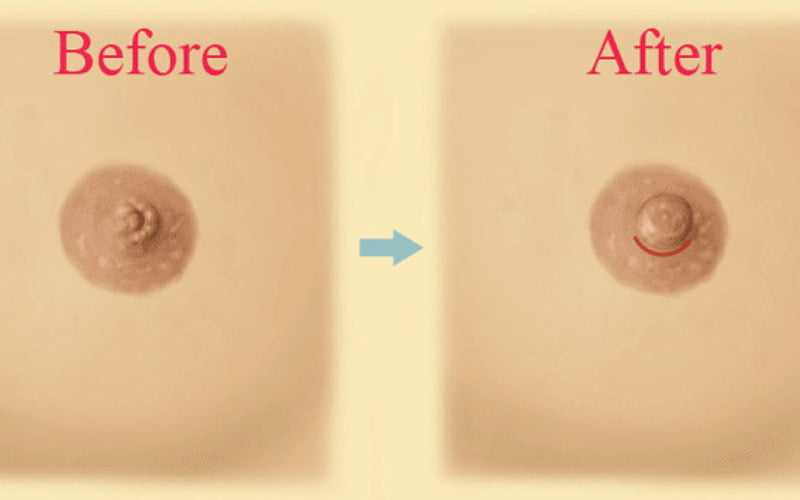 Những ai nên thực hiện phẫu thuật kéo núm vú (Nguồn: Internet)