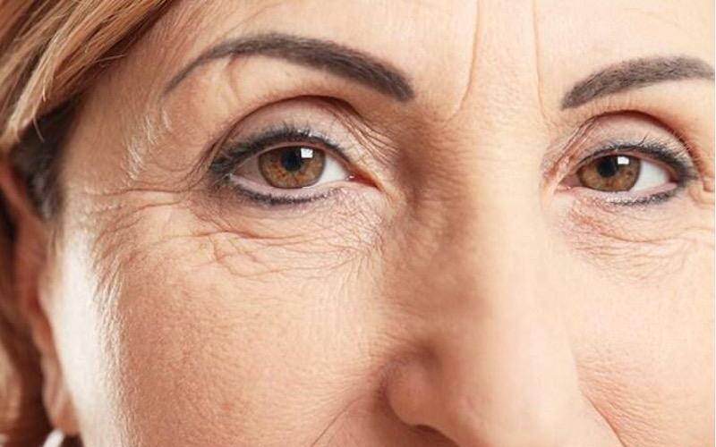 Nếp cau mày (Nguồn: Internet)