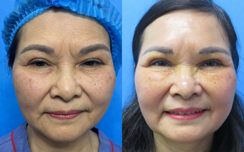 Xóa nếp cau mày tại MD Change Life (Nguồn: Thẩm Mỹ MD Change Life)