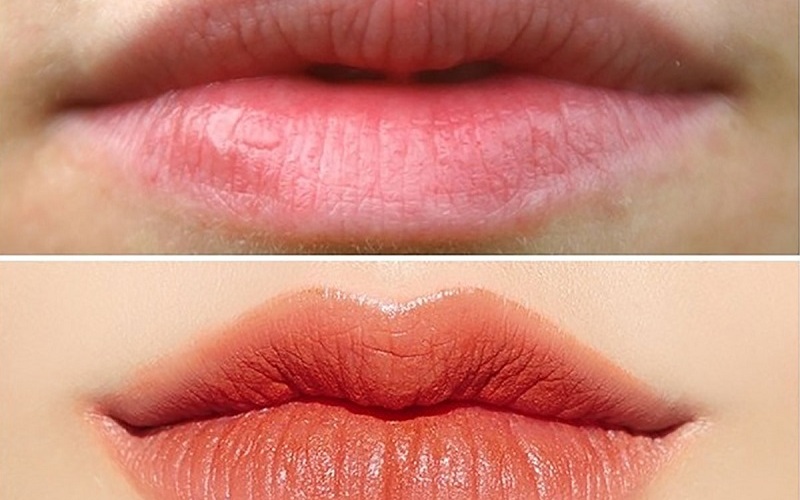 Phẫu thuật tạo khoé cười (Nguồn: Internet)