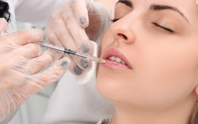 Tiêm filler làm khoé miệng cười (Nguồn: Internet)