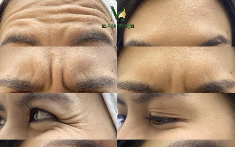 Cắt cơ cau mày (Nguồn: Thẩm mỹ MD Change Life)