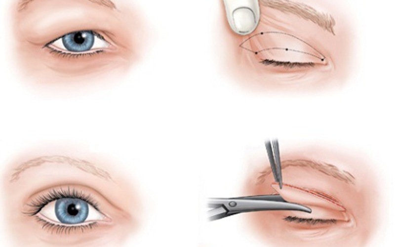 Phương pháp cắt cơ hỗ trợ nâng mí mắt (Nguồn: Internet)