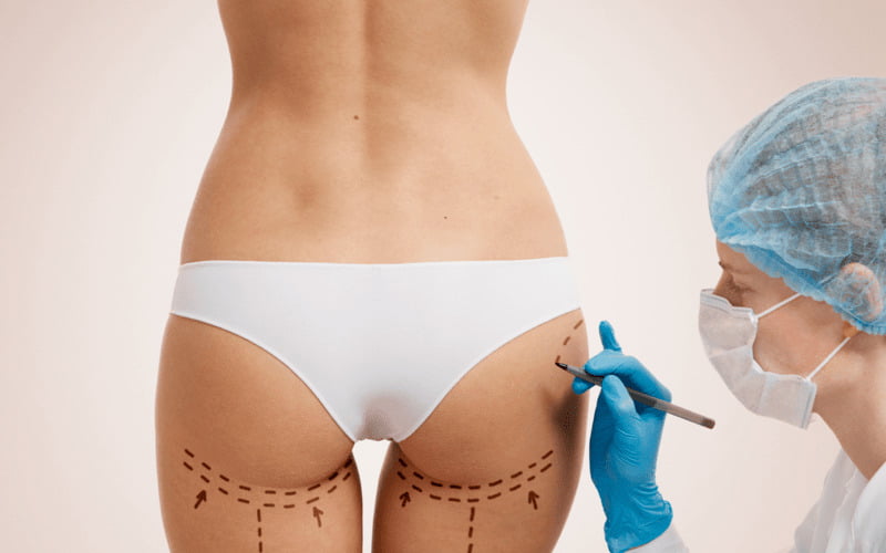 Nâng mông bằng chất liệu độn (Nguồn: Internet)