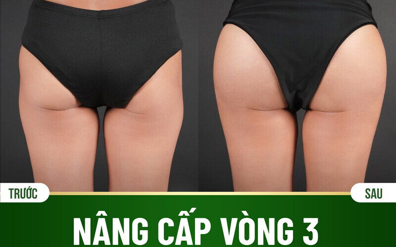 5 địa chỉ nâng mông bằng chất liệu độn Hà Nội uy tín