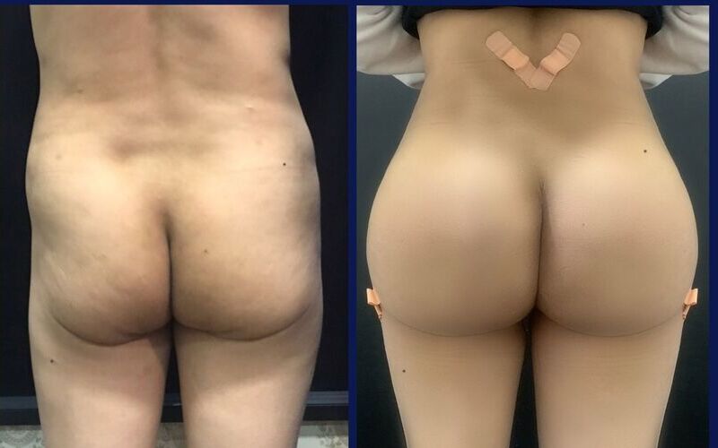 5 địa chỉ nâng mông bằng chất liệu độn Hà Nội uy tín