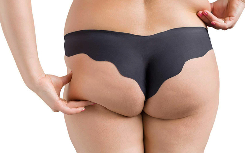 Mông xệ cần nâng (Nguồn: Internet)