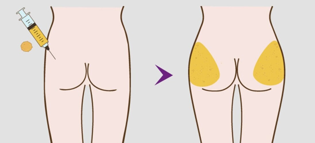 Cấy mỡ mông (Nguồn: Internet)