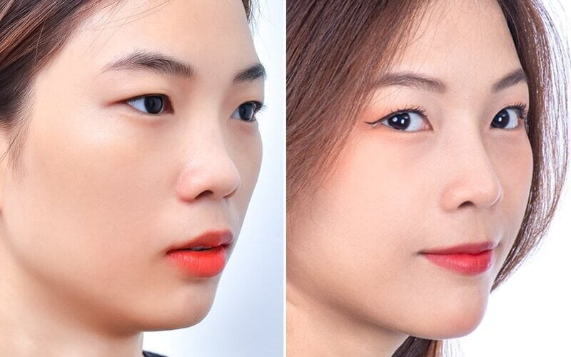 Phẫu thuật nâng mũi có đau không? (Nguồn: Internet)