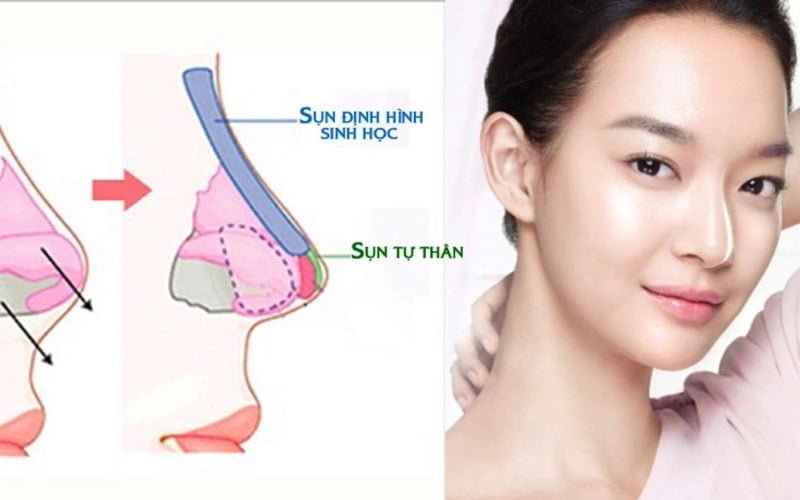 Những trường hợp nên nâng mũi (Nguồn: Internet)