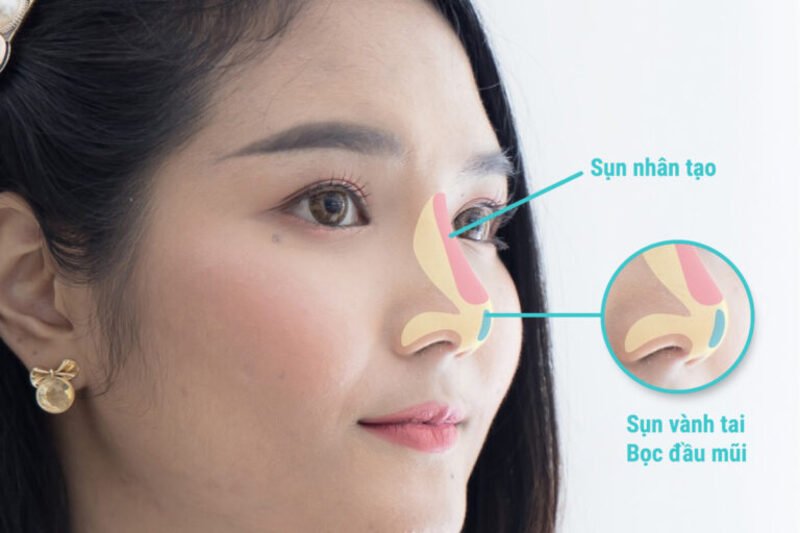 Nâng mũi bán cấu trúc là gì? (Nguồn: Internet)