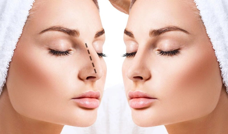 Ưu điểm vượt trội của nâng mũi bán cấu trúc (Nguồn: Internet)