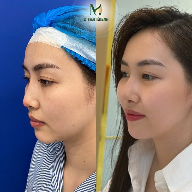 Nâng mũi bán cấu trúc tại Thẩm Mỹ MD Change Life (Nguồn: MD Change Life)