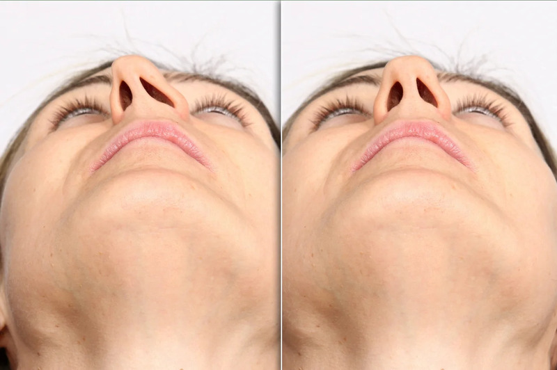 Nâng mũi bị lệch có nắn được không? Giải pháp và lưu ý