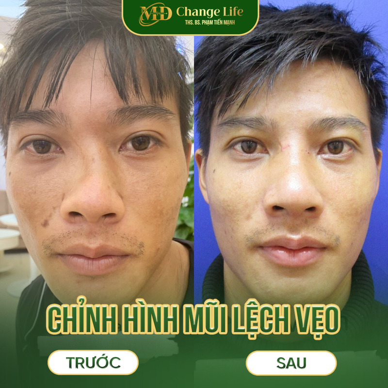 Hình ảnh khách hàng chỉnh sửa mũi lệch tại MD Change Life (Nguồn: MD Change Life)