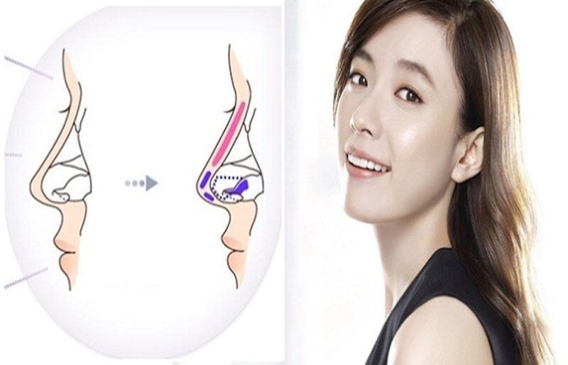 Là phương pháp nhanh chóng giúp bạn có được chiếc mũi ưng ý (Nguồn: Internet)