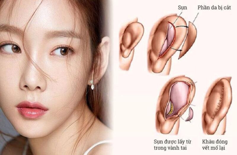 Nâng mũi bọc sụn - phương pháp sửa mũi phổ biến (Nguồn: Internet)