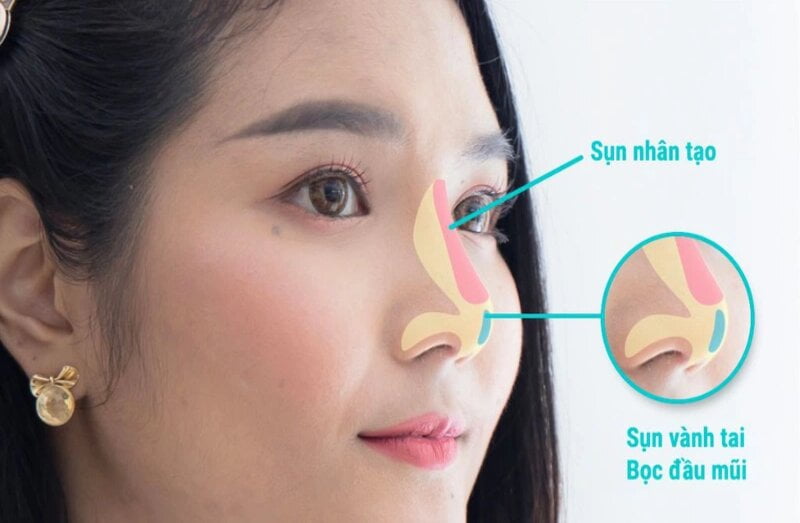 Vậy, nâng mũi bọc sụn có an toàn không? (Nguồn: Internet)