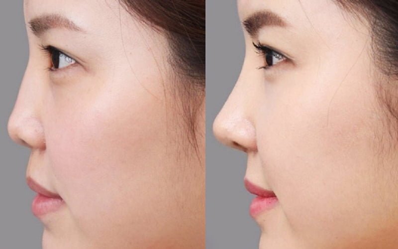 Nâng mũi cấu trúc 4D là kỹ thuật sử dụng sụn nhân tạo hoặc sụn tự thân (sụn vách ngăn, sụn tai) để tái cấu trúc toàn diện cấu trúc mũi (Nguồn: Internet)