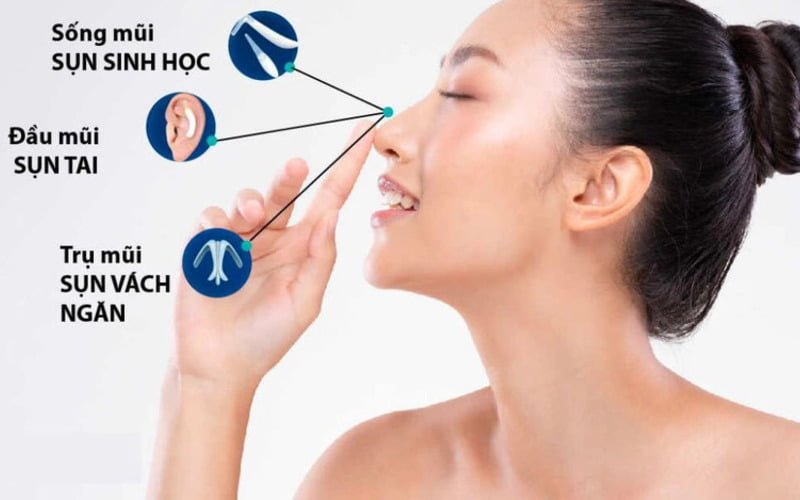 Quy trình thực hiện nâng mũi cấu trúc 4D (Nguồn: Internet)