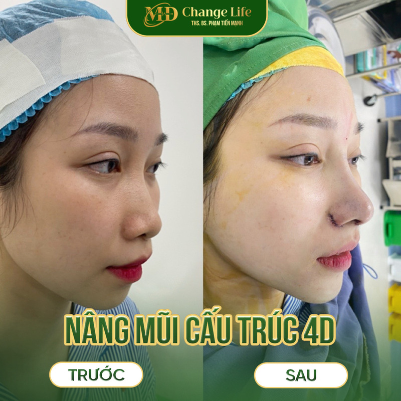 Kết quả khi nâng mũi cấu trúc 4D Hà Nội (Nguồn: MD Change Life)