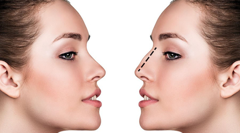 Viện thẩm mỹ y khoa Dr. Hải Lê: Cơ sở nâng mũi cấu trúc 4D Hà Nội (Nguồn: Internet)