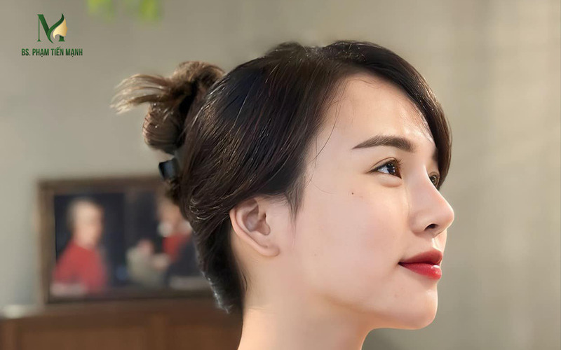 Sửa nâng mũi cấu trúc bị hỏng tại MD Change Life (Nguồn: MD Change Life)