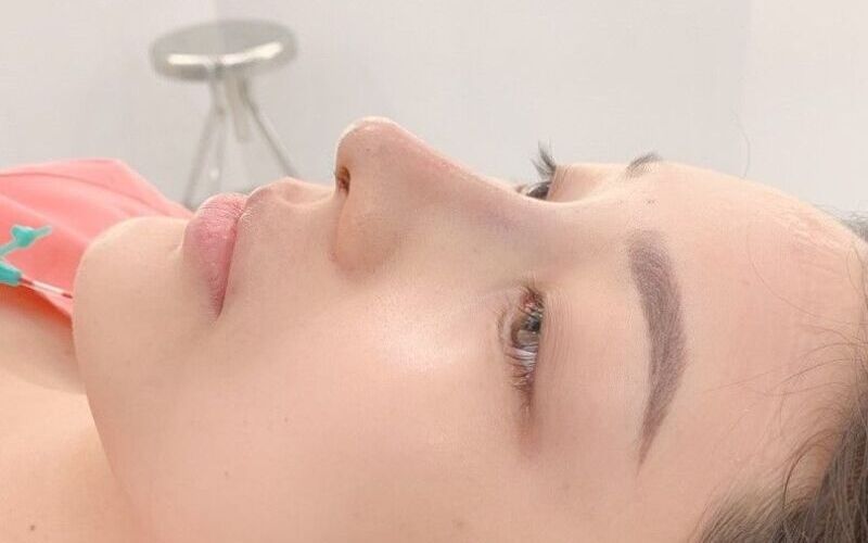 Nâng mũi cấu trúc Surgiform giúp bác sĩ tạo dáng mũi đẹp tự nhiên, phù hợp với từng khuôn mặt (Nguồn: Internet)