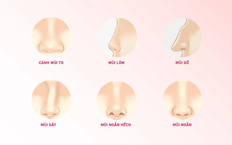 Đối tượng phù hợp với nâng mũi Surgiform (Nguồn: Internet)