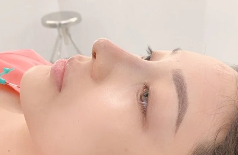 Nâng mũi cấu trúc Surgiform Nghệ An là như thế nào? (Nguồn: Internet)