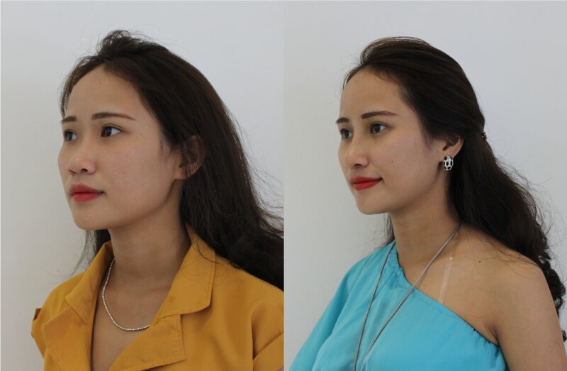 Phù hợp với những người tự ti mũi của mình (Nguồn: Internet)