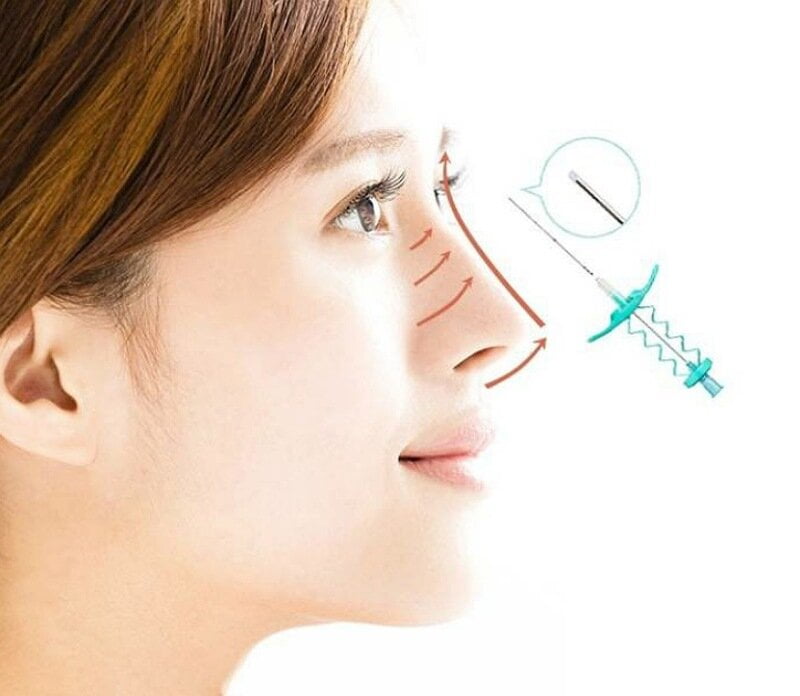 Phương pháp nâng mũi chỉ là như thế nào? (Nguồn: Internet)