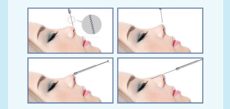 Nâng mũi chỉ là hình thức sửa mũi hồi phục nhanh chóng nhất (Nguồn: Internet)