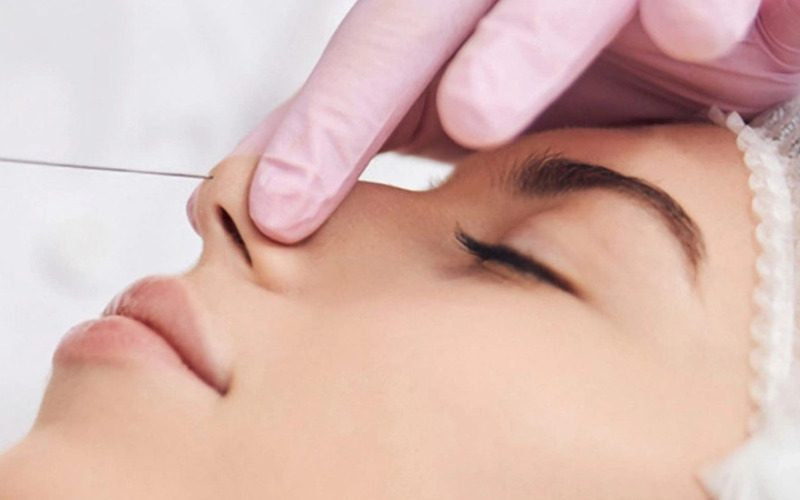 Nâng mũi chỉ collagen là gì?