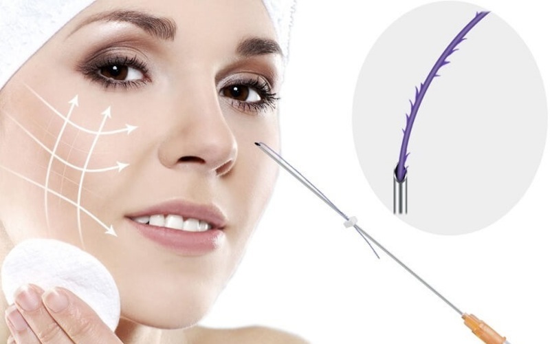 Nâng mũi chỉ collagen là gì?