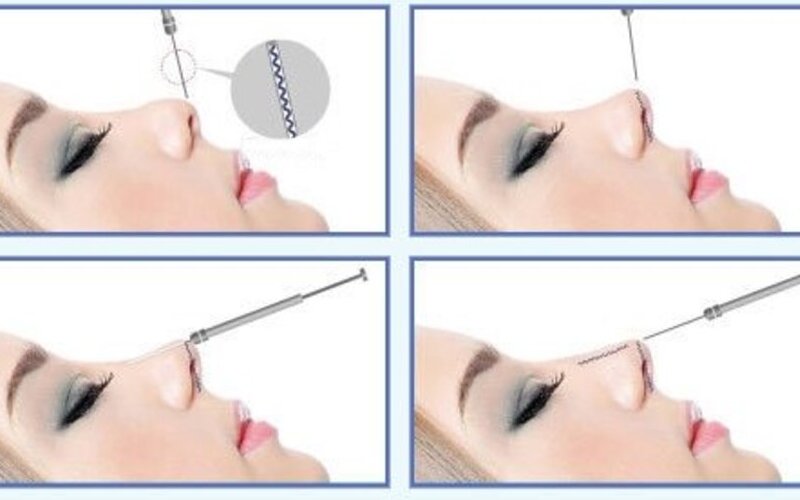 Nâng mũi chỉ collagen là gì?