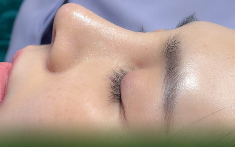 Nâng mũi chỉ collagen là gì?