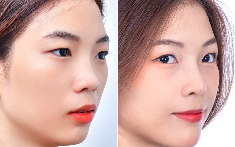 Nâng mũi đặt sống: Bí quyết sở hữu chiếc mũi đẹp