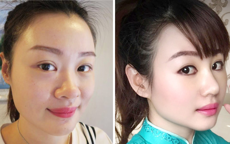 Nâng mũi đẹp tự nhiên: Bí quyết sở hữu dáng mũi hoàn hảo