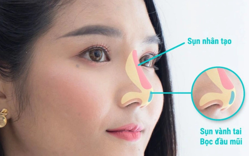 Nâng mũi đẹp tự nhiên: Bí quyết sở hữu dáng mũi hoàn hảo