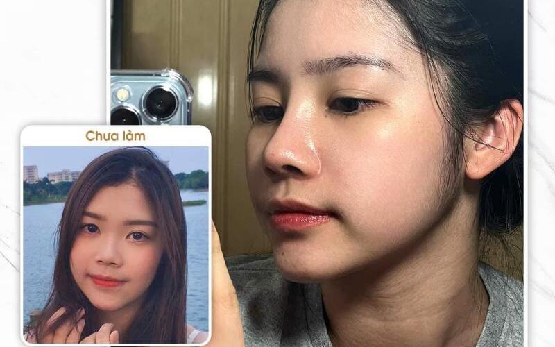 10 địa chỉ nâng mũi Hà Nội chất lượng